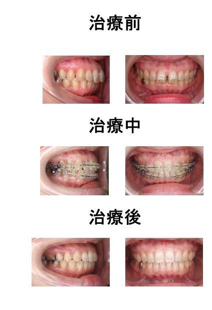 すきっ歯と歯並びの状態をまず正しく知る