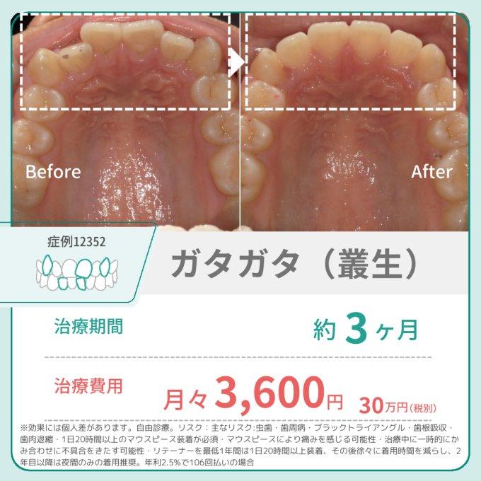 マウスピースで前歯だけ矯正できる症例