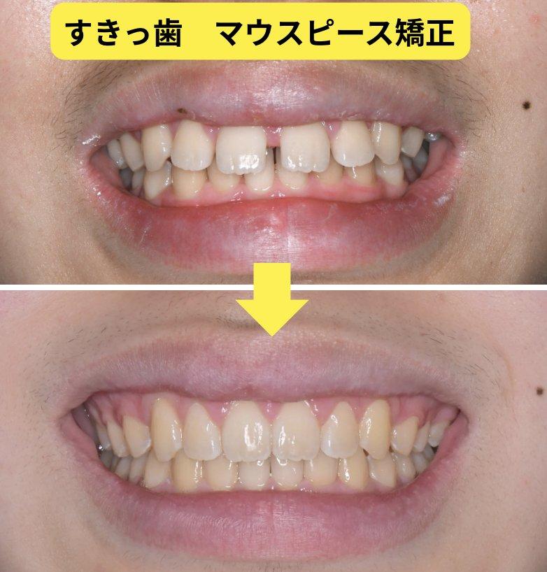すきっ歯をマウスピースで治す費用と期間
