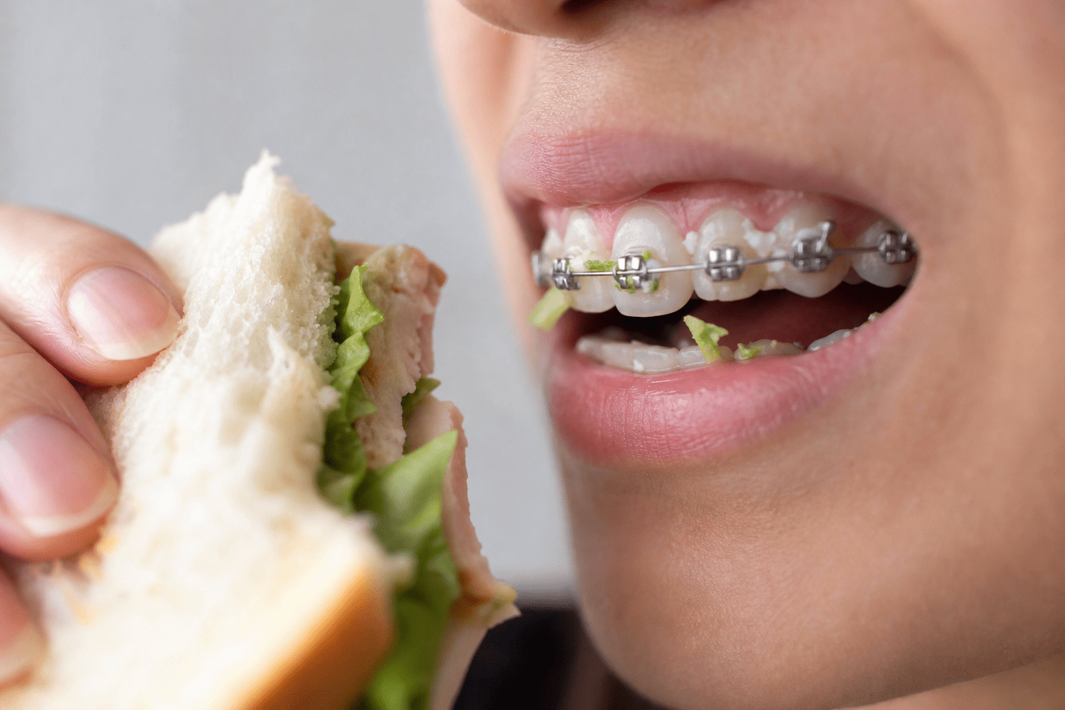 ワイヤー矯正中に食べ物が挟まるのはなぜ？仕組みから理解しよう