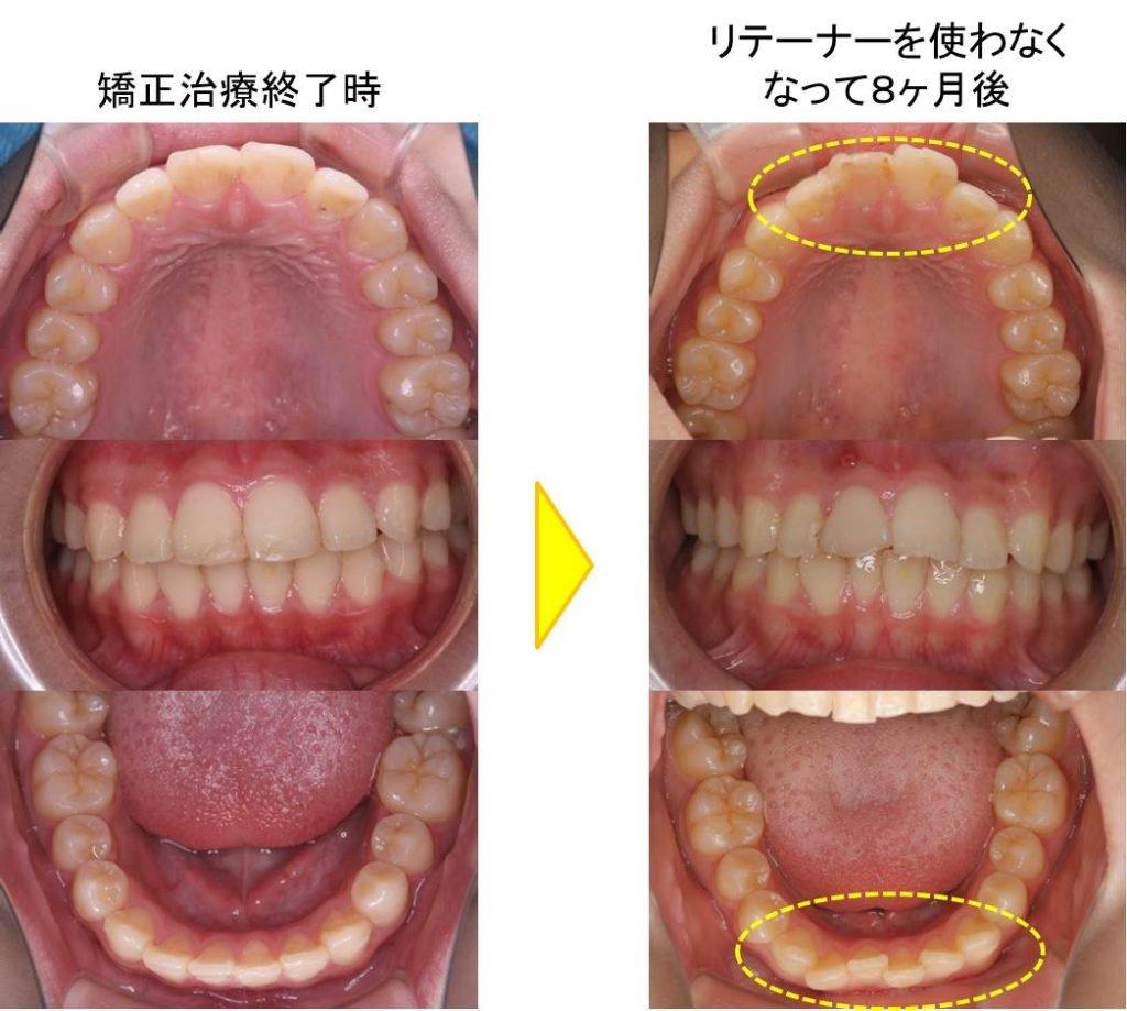 治療後の保定・メンテナンス費用