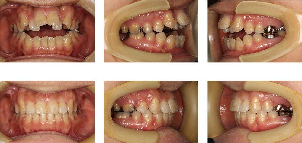 開咬の主な原因とセルフチェックのポイント