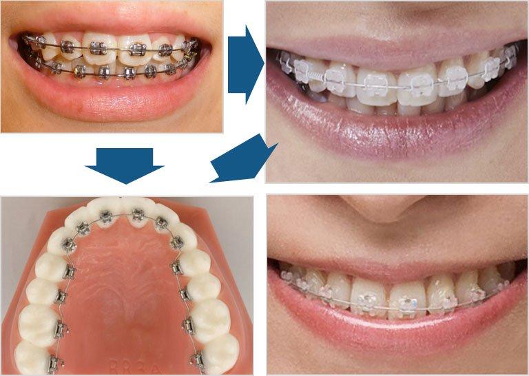 大人の過蓋咬合矯正で注意すべきこと