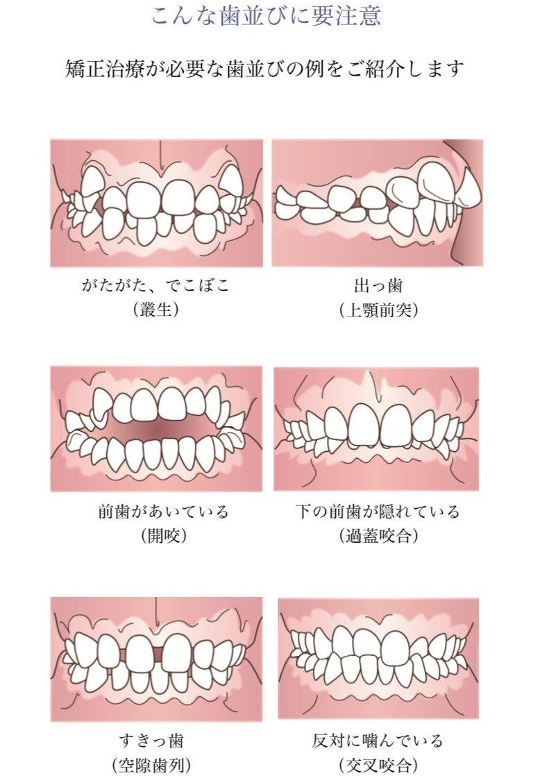 歯並びの悩みを放置しない理由二つ目