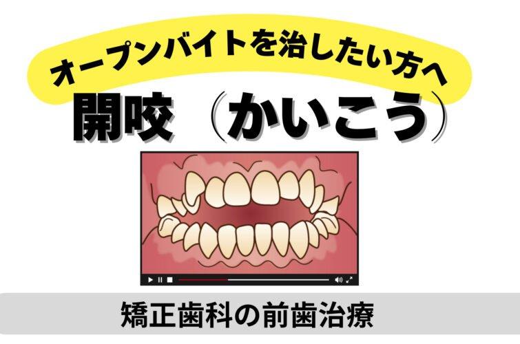 インビザラインで開咬を治したい方への注意点