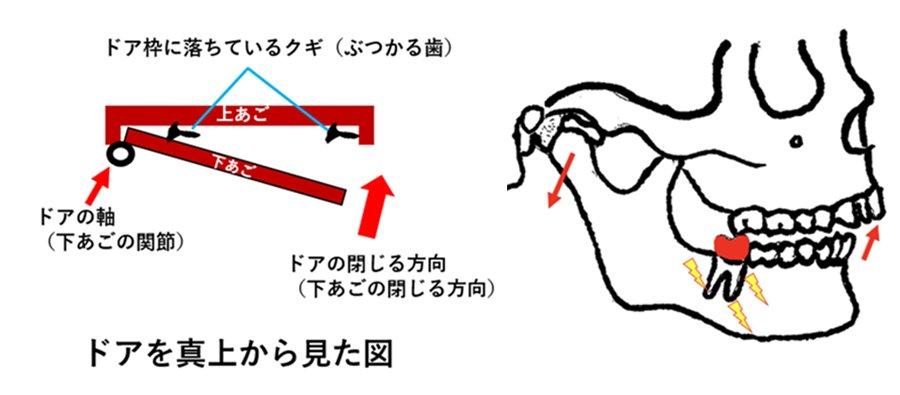 代表的な悪い歯並びの種類とそれぞれの特徴