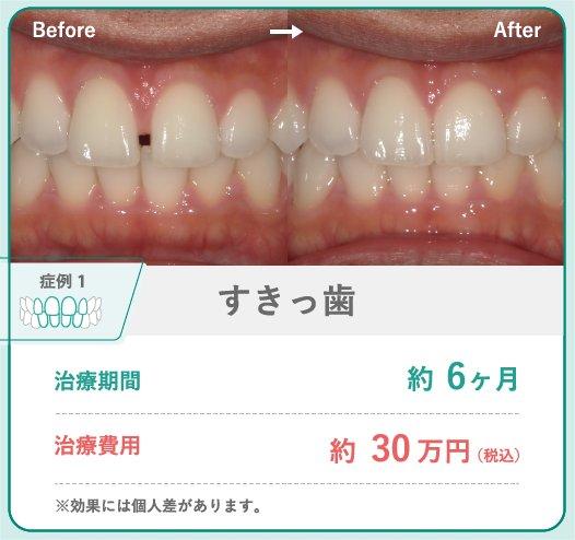 すきっ歯矯正にかかる費用相場と期間の目安
