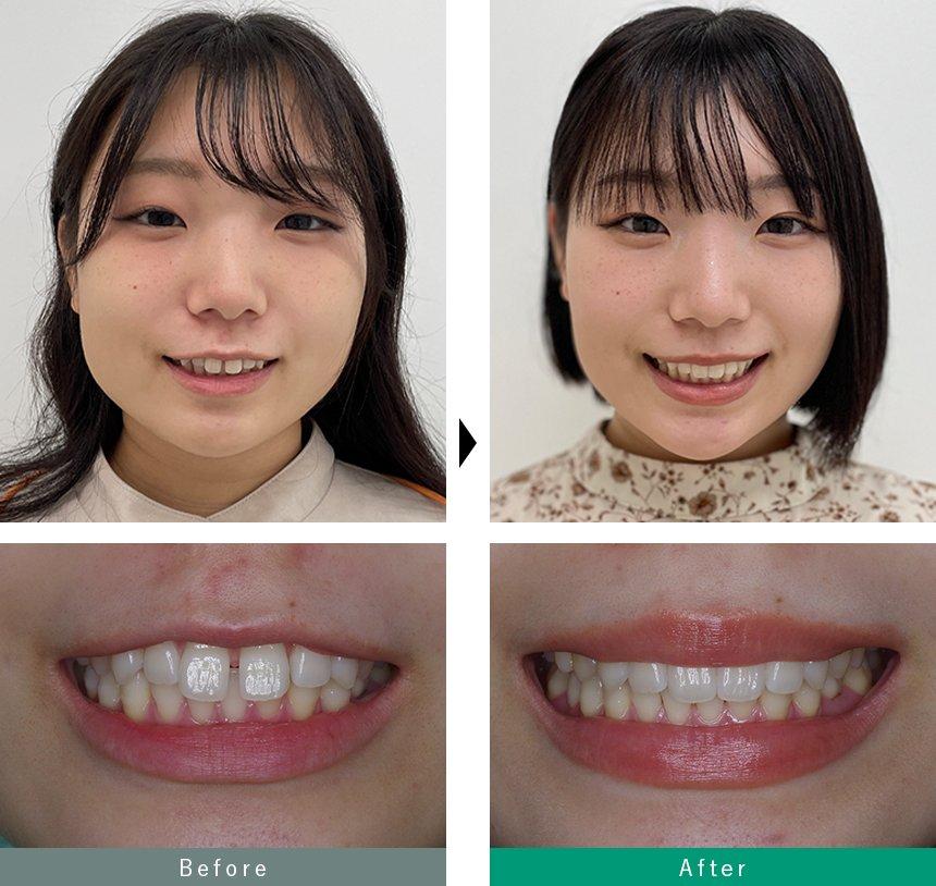 すきっ歯と歯並びの問題をまず正しく理解する