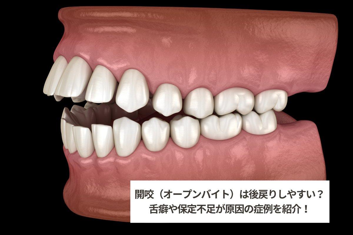 開咬（オープンバイト）とはどんな歯並びか