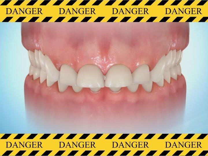 過蓋咬合を放置するリスクと不調