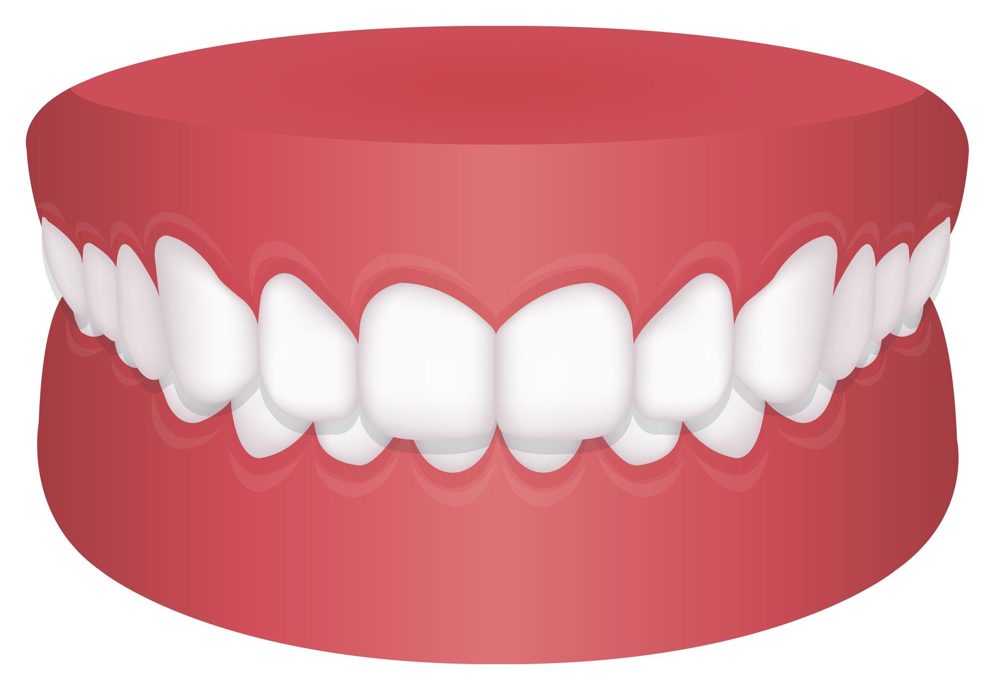 過蓋咬合で保険適用になるケースと条件