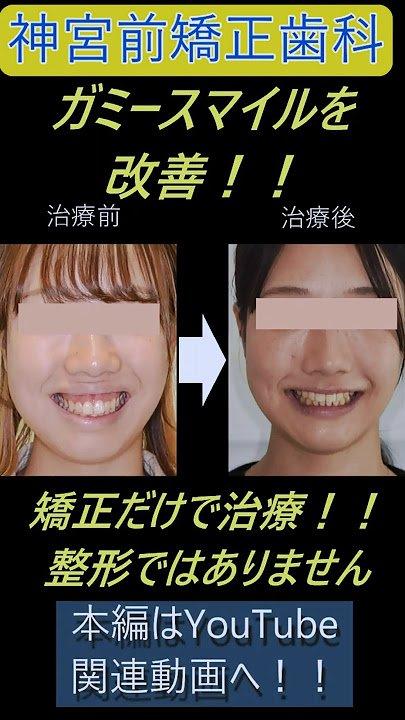 矯正治療で改善できるガミースマイルの範囲