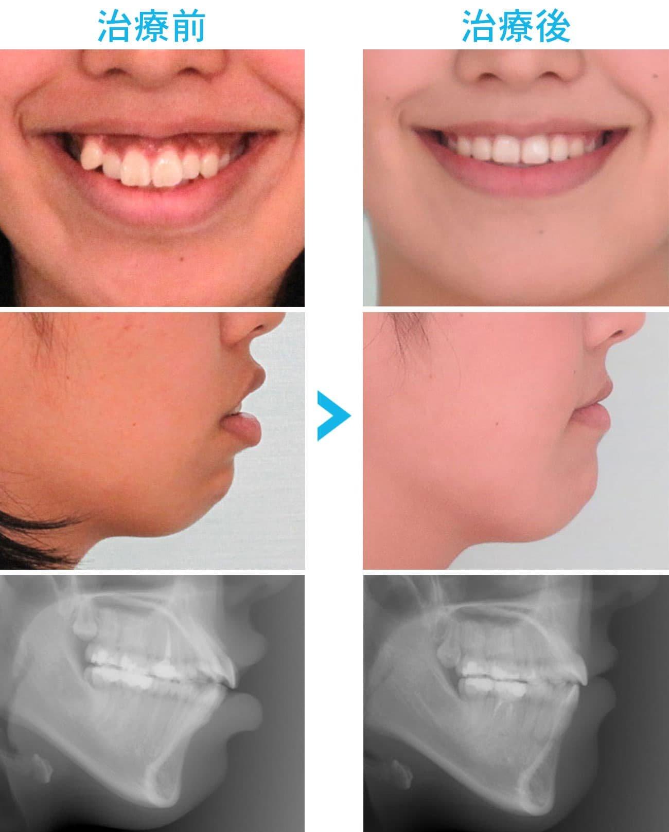 ガミースマイルの主な原因とタイプ別の特徴