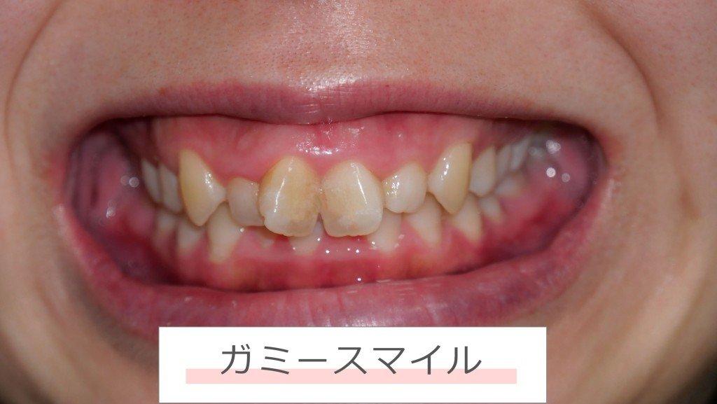 ガミースマイルとは何かをやさしく解説